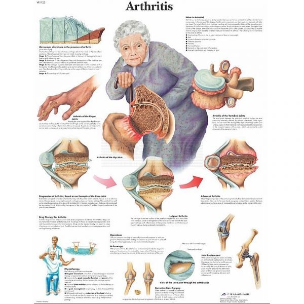 Ingelijste poster Arthritis - artritis 50,5 cm x 67,5 cm